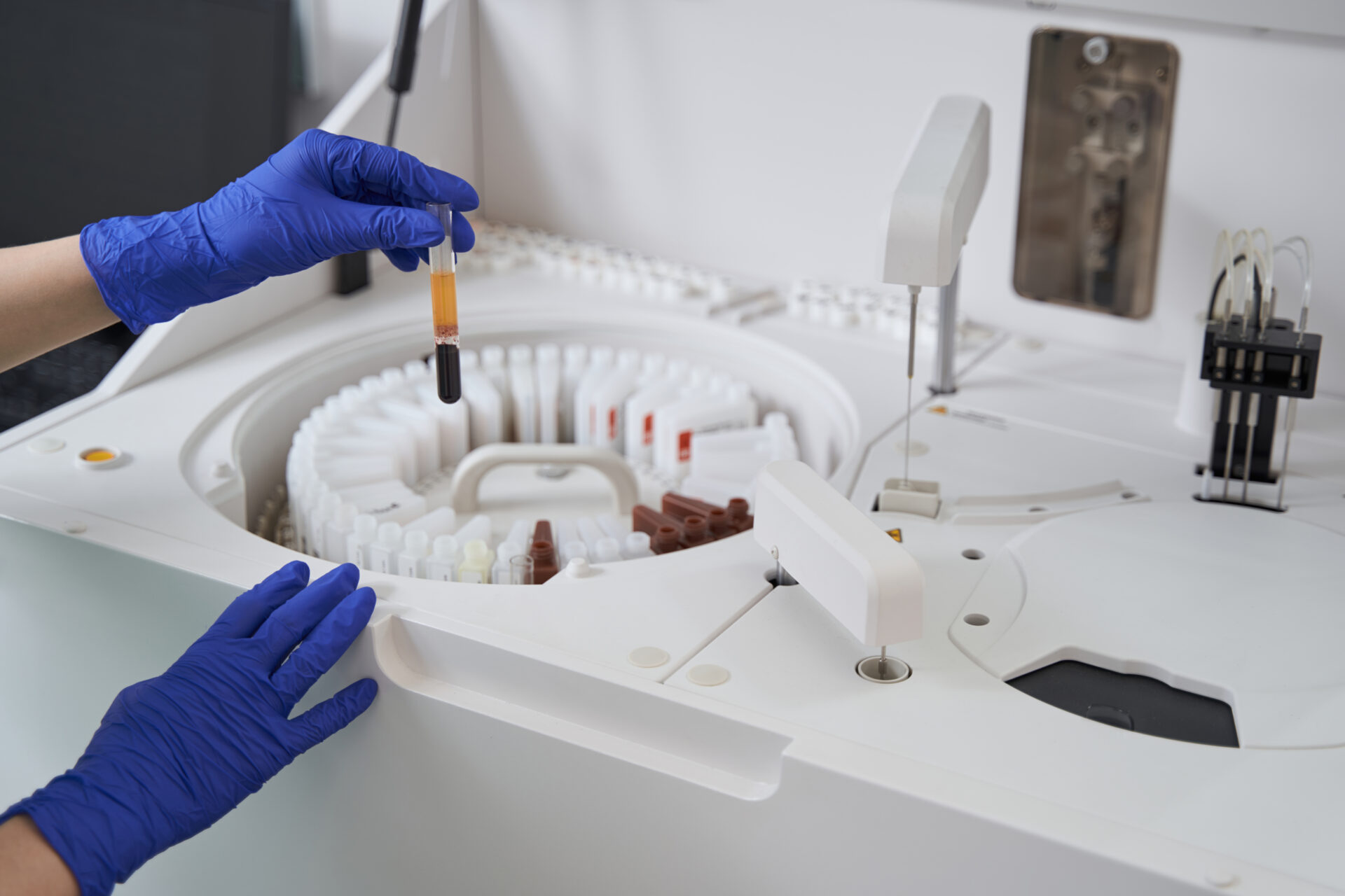 Felç tedavisinde kök hücre tedavisi umut verici sonuçlar sundu